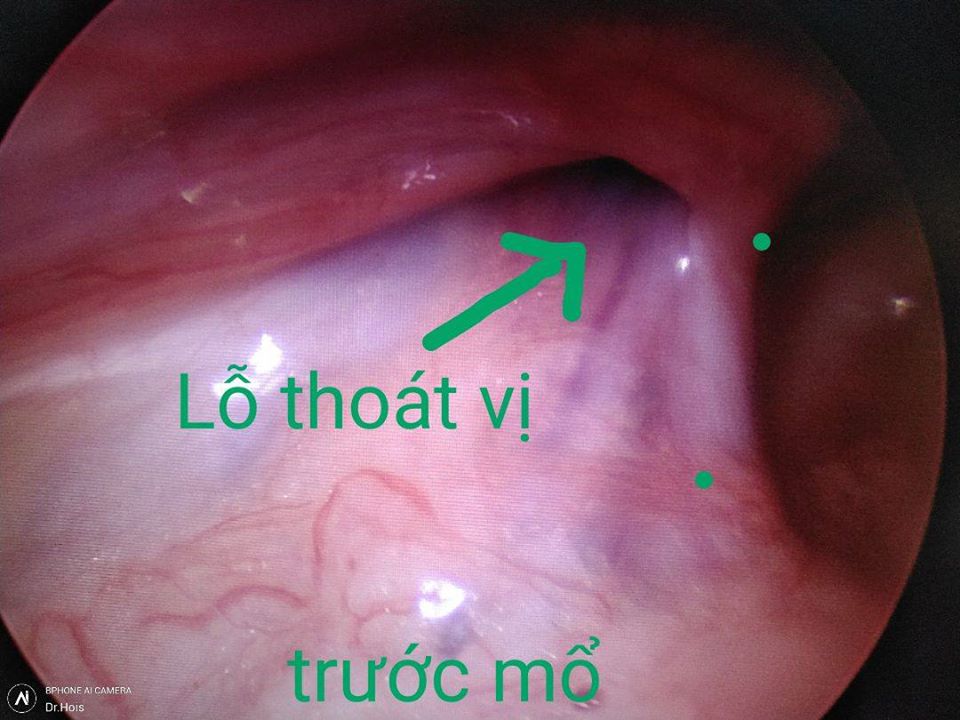 Phương pháp mới trong điều trị thoát vị bẹn ở TRẺ EM